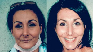 Before and after photo of SCM recipient